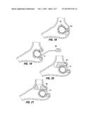 RESTRICTIVE AND/OR OBSTRUCTIVE IMPLANT FOR INDUCING WEIGHT LOSS diagram and image