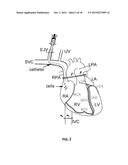 RETROGRADE CORONARY VEIN DELIVERY OF STEM CELLS diagram and image