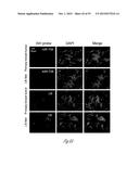 TREATMENT OF METASTATIC BREAST CANCER diagram and image