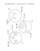 COLLECTING AND HARVESTING CUT BONE FROM KERRISON RONGEUR diagram and image