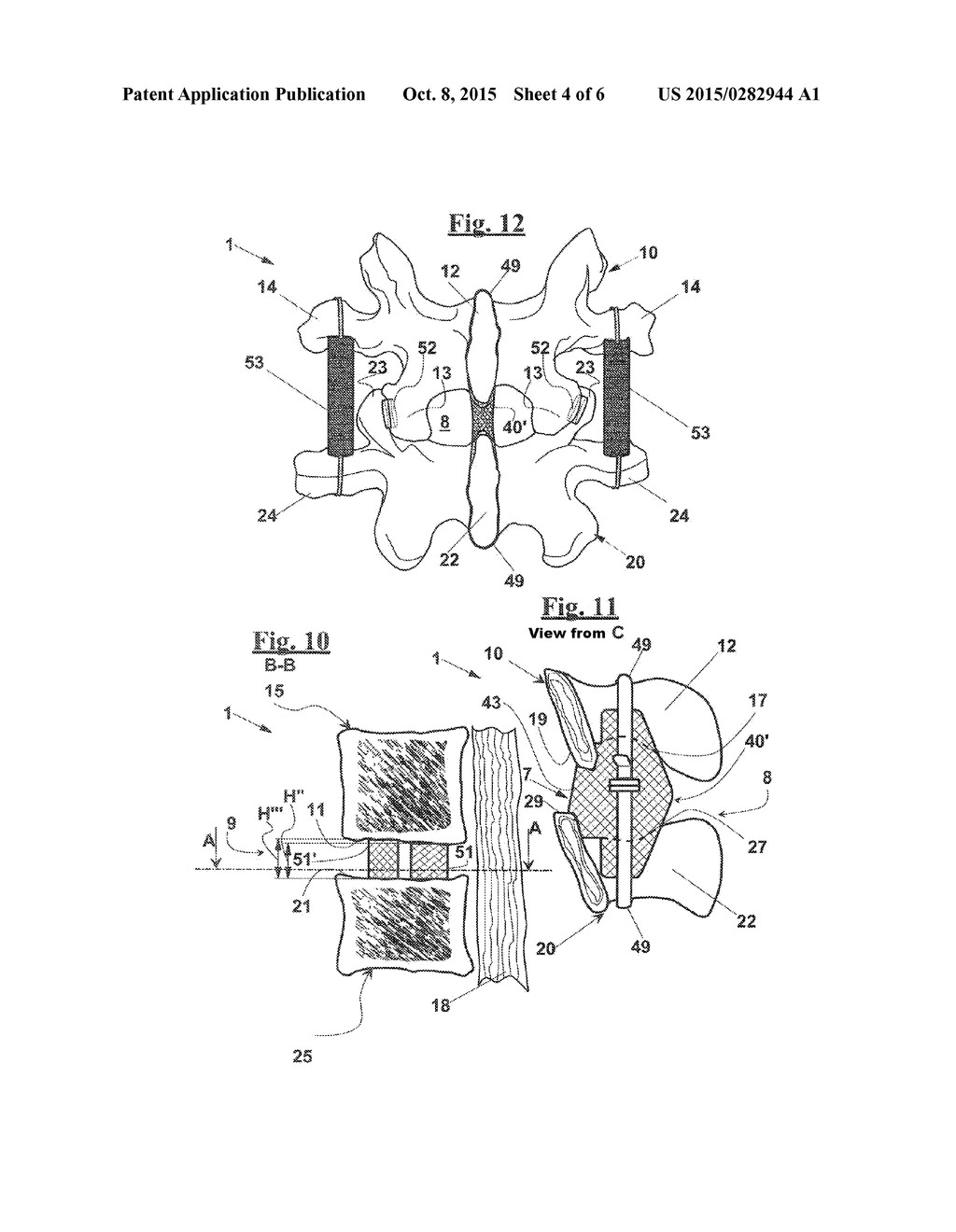 VERTEBRAL FUSION DEVICE AND SYSTEM - diagram, schematic, and image 05