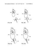 INTERCOSTAL DELIVERY SYSTEM AND METHODS THEREOF diagram and image