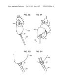 INTERCOSTAL DELIVERY SYSTEM AND METHODS THEREOF diagram and image