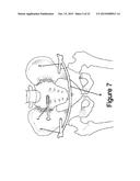 Method and Apparatus for Minimally Invasive Treatment of Unstable Pelvic     Ring Injuries Combined with Hip Arthroplasty diagram and image