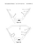 Method and Apparatus for Minimally Invasive Treatment of Unstable Pelvic     Ring Injuries Combined with Hip Arthroplasty diagram and image