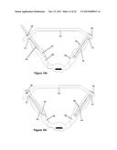 Method and Apparatus for Minimally Invasive Treatment of Unstable Pelvic     Ring Injuries Combined with Hip Arthroplasty diagram and image