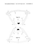 Method and Apparatus for Minimally Invasive Treatment of Unstable Pelvic     Ring Injuries Combined with Hip Arthroplasty diagram and image