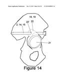 Method and Apparatus for Minimally Invasive Treatment of Unstable Pelvic     Ring Injuries Combined with Hip Arthroplasty diagram and image