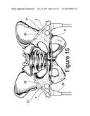 Method and Apparatus for Minimally Invasive Treatment of Unstable Pelvic     Ring Injuries Combined with Hip Arthroplasty diagram and image