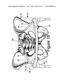 Method and Apparatus for Minimally Invasive Treatment of Unstable Pelvic     Ring Injuries Combined with Hip Arthroplasty diagram and image