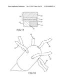 Magnetically guided catheters diagram and image