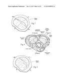 Devices, Systems, and Methods for Reshaping a Heart Valve Annulus,     Including the Use of a Bridge Implant Having an Adjustable Bridge Stop diagram and image