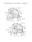 Devices, Systems, and Methods for Reshaping a Heart Valve Annulus,     Including the Use of a Bridge Implant Having an Adjustable Bridge Stop diagram and image