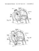 Devices, Systems, and Methods for Reshaping a Heart Valve Annulus,     Including the Use of a Bridge Implant Having an Adjustable Bridge Stop diagram and image