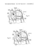 Devices, Systems, and Methods for Reshaping a Heart Valve Annulus,     Including the Use of a Bridge Implant Having an Adjustable Bridge Stop diagram and image