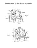 Devices, Systems, and Methods for Reshaping a Heart Valve Annulus,     Including the Use of a Bridge Implant Having an Adjustable Bridge Stop diagram and image