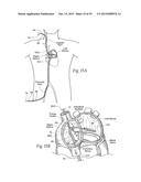 Devices, Systems, and Methods for Reshaping a Heart Valve Annulus,     Including the Use of a Bridge Implant Having an Adjustable Bridge Stop diagram and image