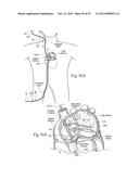 Devices, Systems, and Methods for Reshaping a Heart Valve Annulus,     Including the Use of a Bridge Implant Having an Adjustable Bridge Stop diagram and image