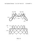 Valve Prosthesis and Method for Delivery diagram and image