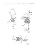 PERCUTANEOUS IMPLANT diagram and image