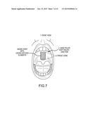 Non-Surgical Method and System for Reducing Snoring diagram and image