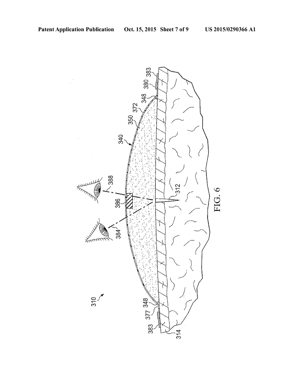 Reduced-Pressure Dressing Assemblies For Use In Applying A Closing Force - diagram, schematic, and image 08