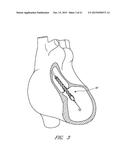 CATHETER PUMP WITH ACCESS PORTS diagram and image