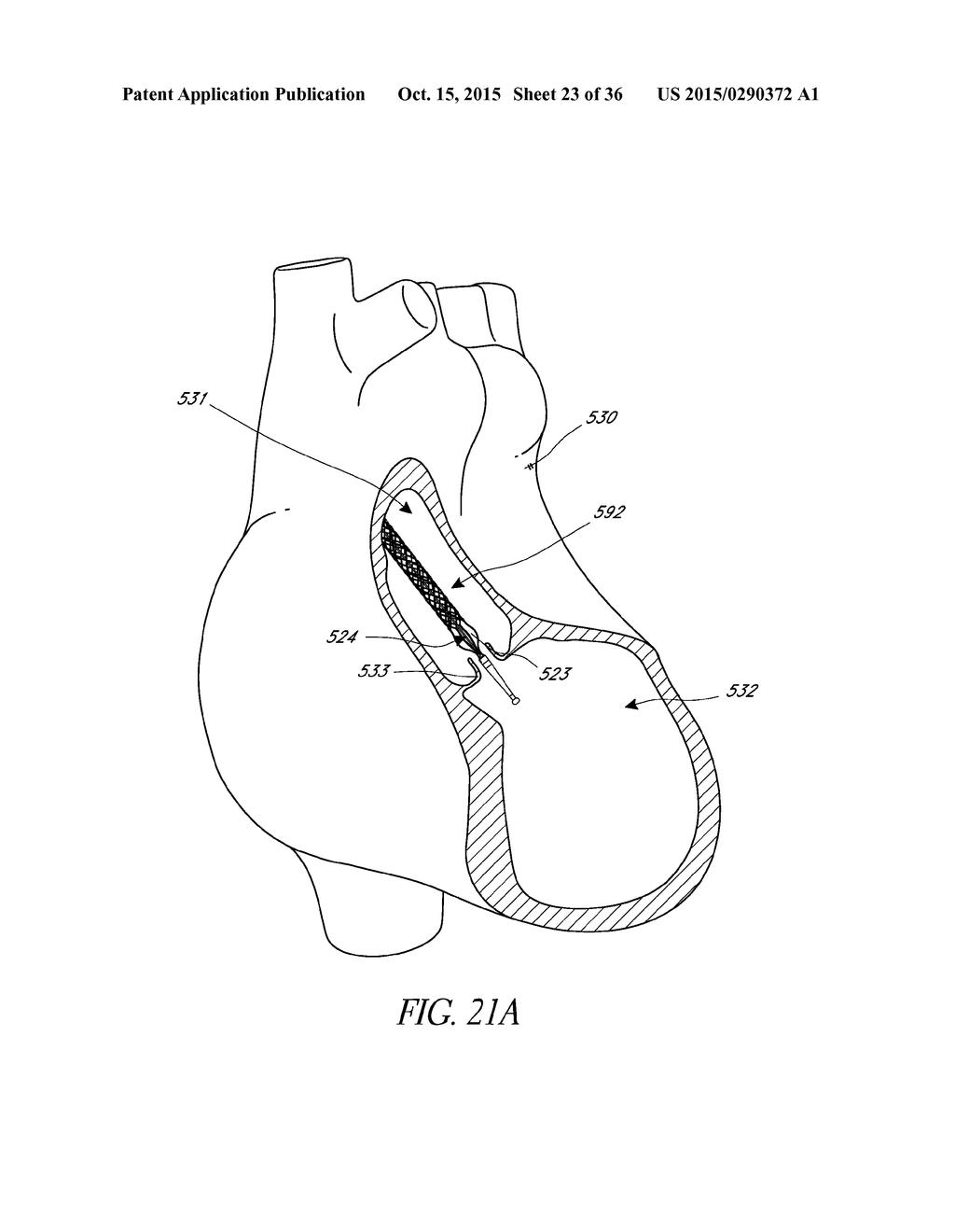 SENSORS FOR CATHETER PUMPS - diagram, schematic, and image 24