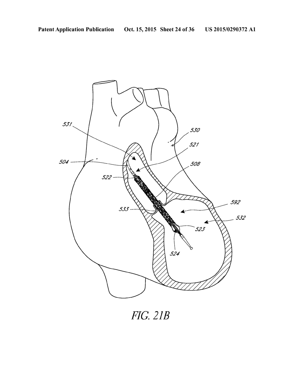 SENSORS FOR CATHETER PUMPS - diagram, schematic, and image 25