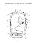 METHODS AND SYSTEMS FOR UPGRADING VENTRICLE ASSIST DEVICES diagram and image