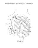 DIALYSIS CATHETER diagram and image