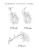 DIALYSIS CATHETER diagram and image