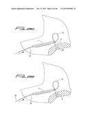 DIALYSIS CATHETER diagram and image