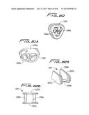 DIALYSIS CATHETER diagram and image