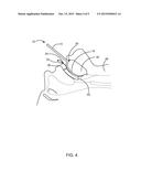 Airway Opening Device diagram and image