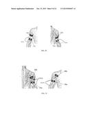 ELECTRICAL STIMULATION DEVICE AND METHOD FOR THE TREATMENT OF NEUROLOGICAL     DISORDERS diagram and image