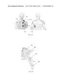 ELECTRICAL STIMULATION DEVICE AND METHOD FOR THE TREATMENT OF NEUROLOGICAL     DISORDERS diagram and image