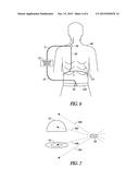 NON-INVASIVE LUNG PACING diagram and image