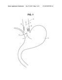 METHODS AND SYSTEMS FOR TREATMENT OF TISSUE IN A BODY LUMEN diagram and image