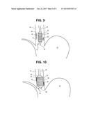 METHODS AND SYSTEMS FOR TREATMENT OF TISSUE IN A BODY LUMEN diagram and image