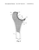 INTRA-ARTICULAR JOINT REPLACEMENT diagram and image