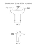 CATARACT REMOVAL DEVICE AND INTEGRATED TIP diagram and image