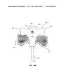 Antimicrobial/Haemostatic Interface Pad for Placement Between     Percutaneously Placed Medical Device And Patient Skin diagram and image