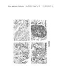 B7-H3 AS A BIOMARKER FOR DIAGNOSING THE PROGRESSION AND EARLY LYMPH NODE     METASTASIS OF CANCER diagram and image