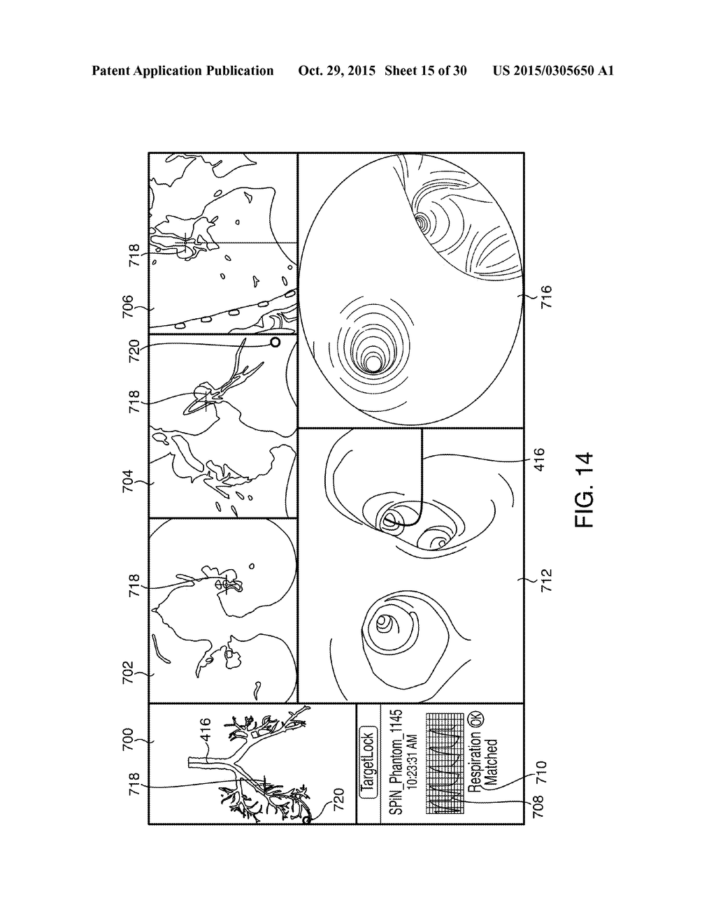 APPARATUSES AND METHODS FOR ENDOBRONCHIAL NAVIGATION TO AND CONFIRMATION     OF THE LOCATION OF A TARGET TISSUE AND PERCUTANEOUS INTERCEPTION OF THE     TARGET TISSUE - diagram, schematic, and image 16