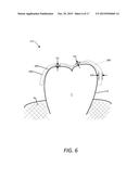 SYSTEM FOR MEASURING TEETH MOVEMENT AND CONTACT PRESSURE diagram and image