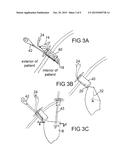 TISSUE SPECIMEN RETRIEVAL BAG, METHOD FOR RETRIEVING TISSUE diagram and image