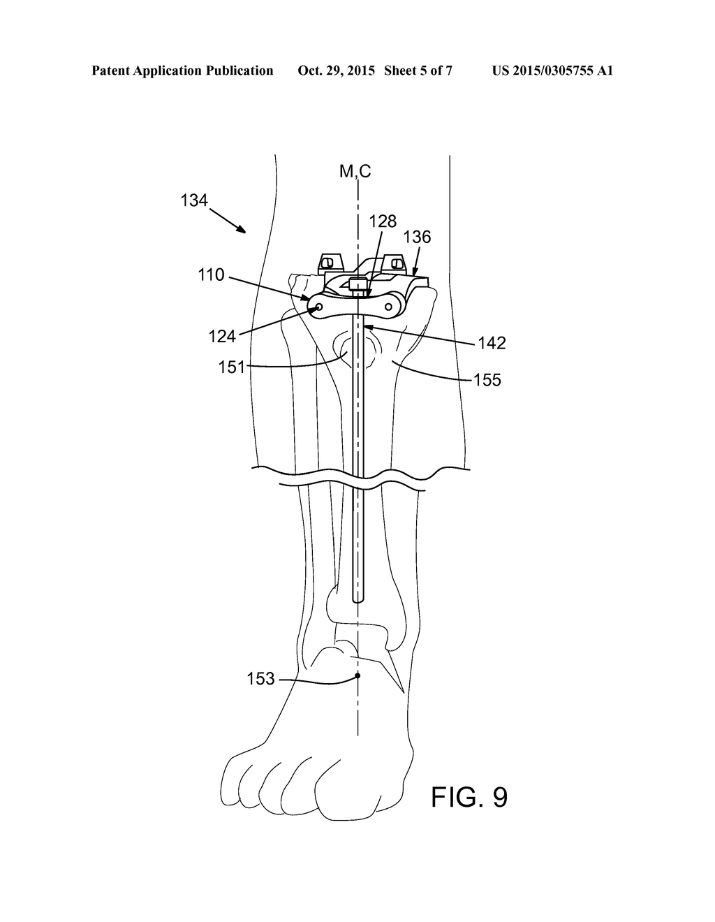 DRILL GUIDES FOR CONFIRMING ALIGNMENT OF PATIENT-SPECIFIC ALIGNMENT GUIDES - diagram, schematic, and image 06