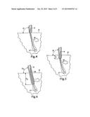 FOLLICULAR EXTRACTION PUNCH AND METHOD diagram and image