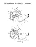 TISSUE EXTRACTION DEVICES AND RELATED METHODS diagram and image